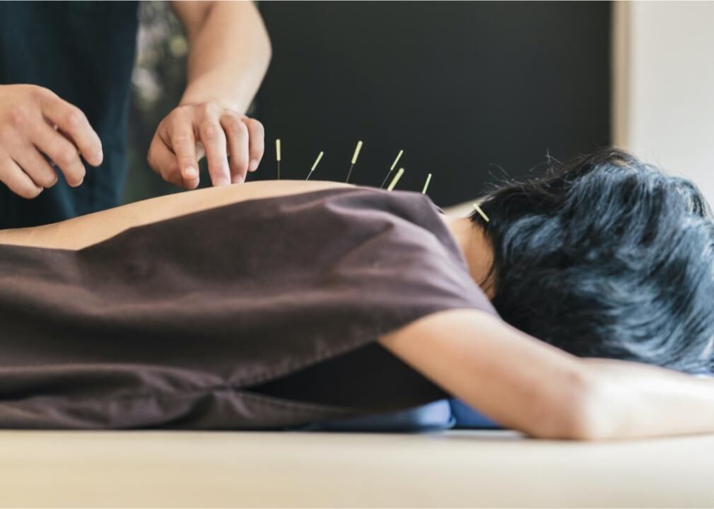 Acupuncture